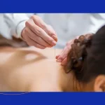 Illustration of a patient receiving acupuncture treatment for lower back pain.