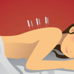 Woman with back pain receives acupuncture therapy