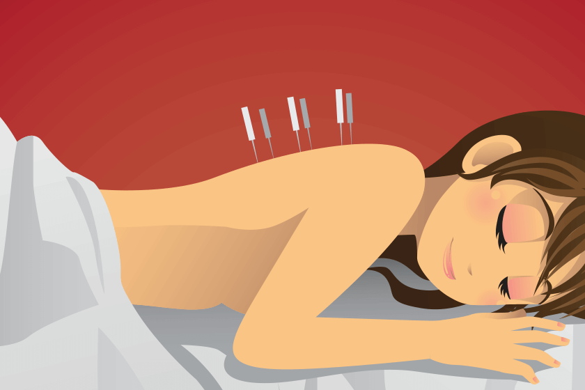 Woman with back pain receives acupuncture therapy