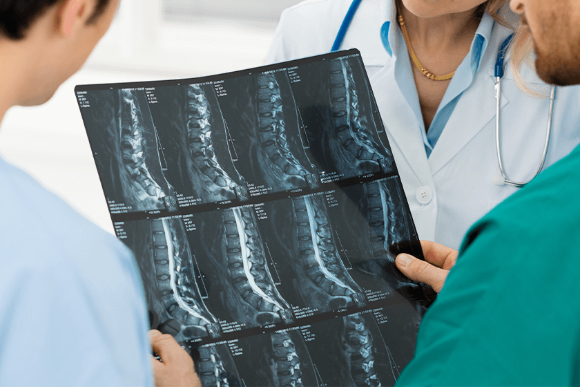 doctors looking at mri of spondylosis, spondylitis, spondylolisthesis