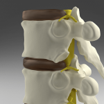 what causes spinal stenosis