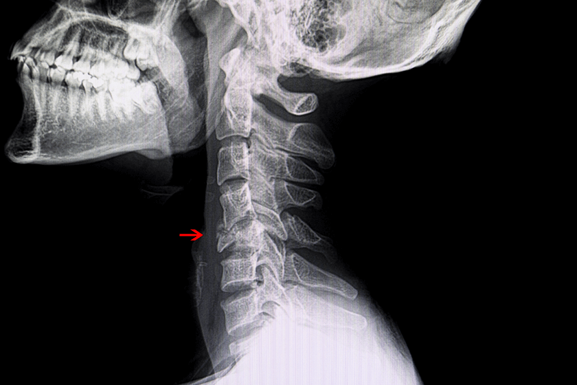 vertebral compression fracture
