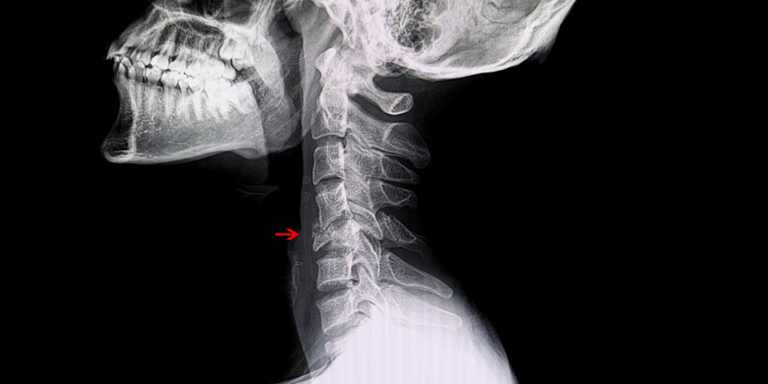 Vertebral Compression Fractures - Symptoms and Treatments