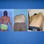 images of children with pediatric spinal deformities