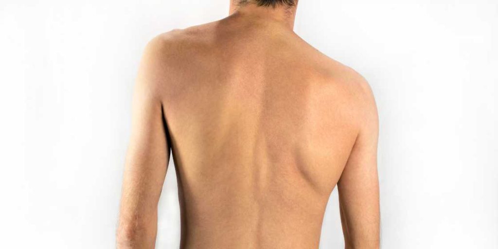 What Causes Scoliosis? Symptoms, Treatment, and Care at Neuro
