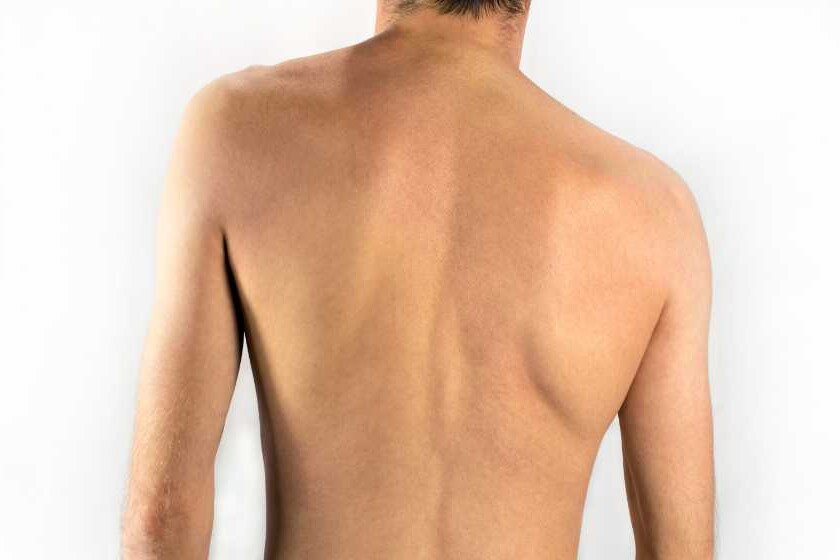 scoliosis in adults symptoms