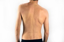 the back of a man with scoliosis