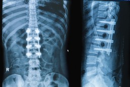 x-ray of spinal cord injury post-surgery