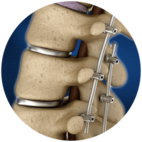 Failed Back Syndrome in NJ & NY | Advanced Spine Center