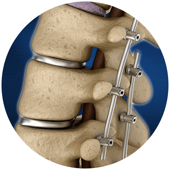Failed Back Syndrome  The Advanced Spine Center