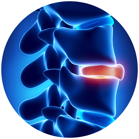 Herniated Disc - Causes, Symptoms & Treatment