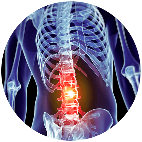 Anterior Lumbar Interbody Fusion | Advanced Spine Relief