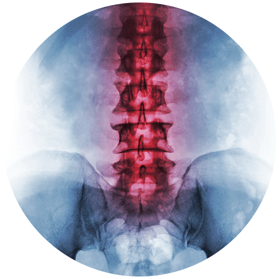 Ankylosing Spondylitis Symptoms And Treatments Advanced Spine