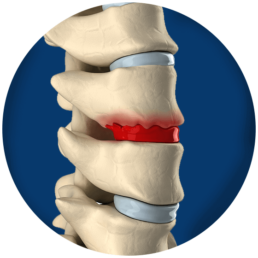 Bone Spurs | The Advanced Spine Center