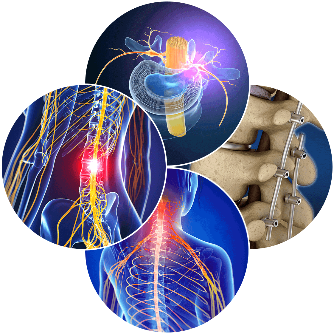 Spinal Cord Stimulator