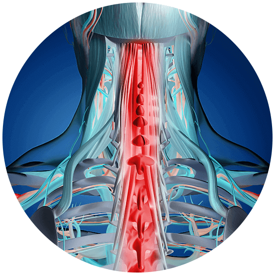 Neck Sprains and Strains - OrthoInfo - AAOS