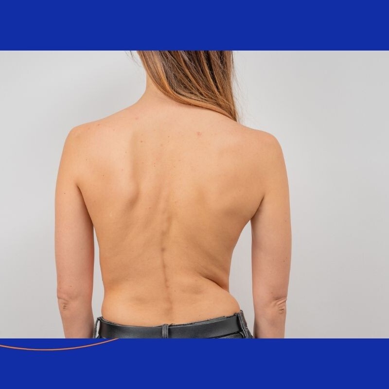 womans back scoliosis