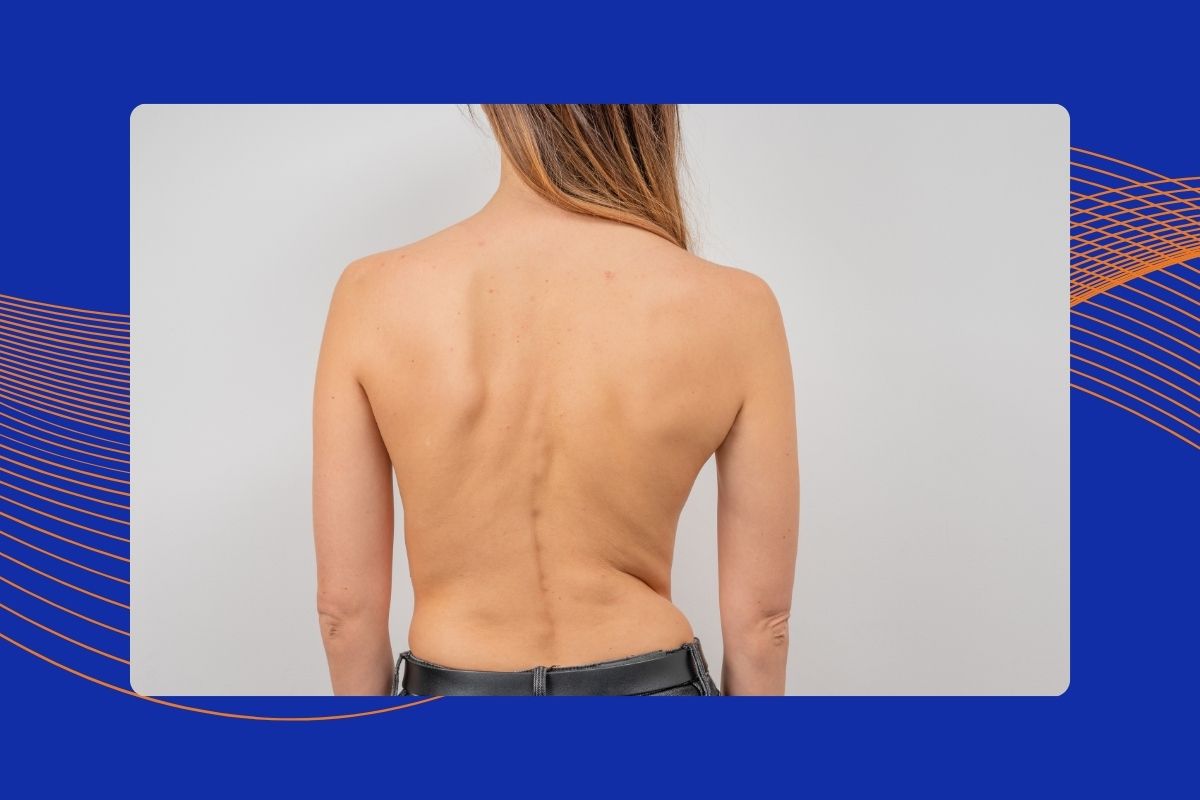 womans back scoliosis