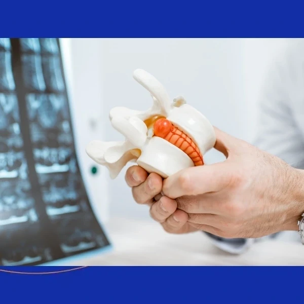 Close-up of a doctor holding a lumbar vertebral model with an artificial disc implant at The Advanced Spine Center