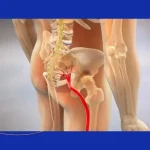 Sciatica Surgery_ Treatment Options for Leg Pain Relief in Morristown, NJ