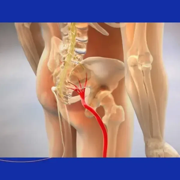 Sciatica Surgery_ Treatment Options for Leg Pain Relief in Morristown, NJ