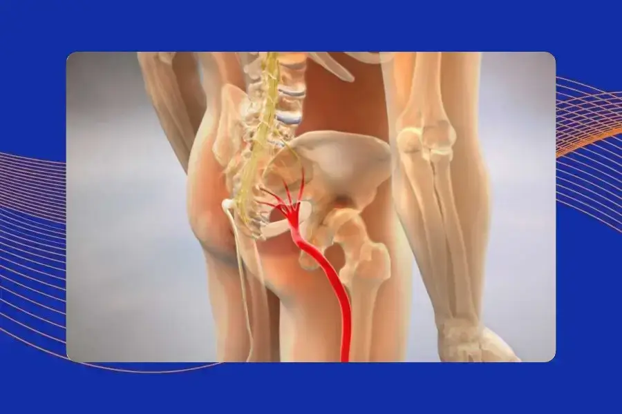 Sciatica Surgery_ Treatment Options for Leg Pain Relief in Morristown, NJ